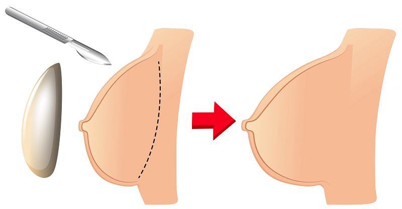 Is My Breast Augmentation Is Dropping Normally?